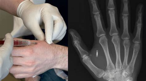 how are rfid chips implanted|Everything You Need To Know Before Getting An RFID Implant.